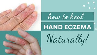 How to Treat & Prevent HAND Eczema Naturally