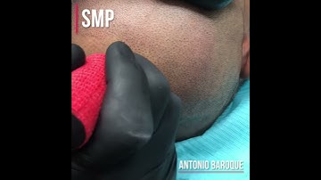 Scalp Micropigmentation (A quick demo)