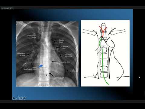Video: 3 cách để chẩn đoán Diverticulum thực quản