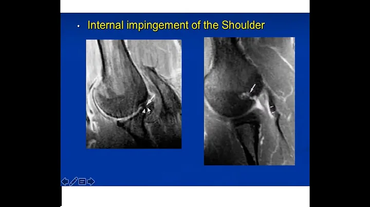 Shoulder Injuries in Throwing Athletes