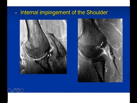 Shoulder Injuries in Throwing Athletes - YouTube