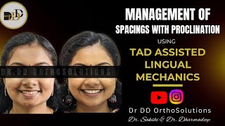 Management of Spacings with Proclination using TAD Assisted Lingual Mechanics.