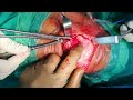 Pre-patellar Bursitis | Bursa removal | Knee injuries | Pre-patellar Bursa Excision | Adamya Hosp Vd
