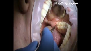 Малоинвазивная хирургия. Удаление зуба 3 8.(, 2016-04-02T11:44:21.000Z)