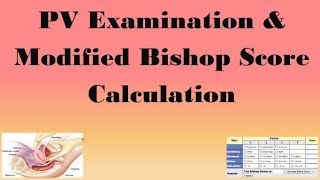 PV Examination & Modified Bishop Score Calculation screenshot 3