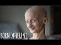 Progeria Has Taken My Teeth But Not My Smile | BORN DIFFERENT