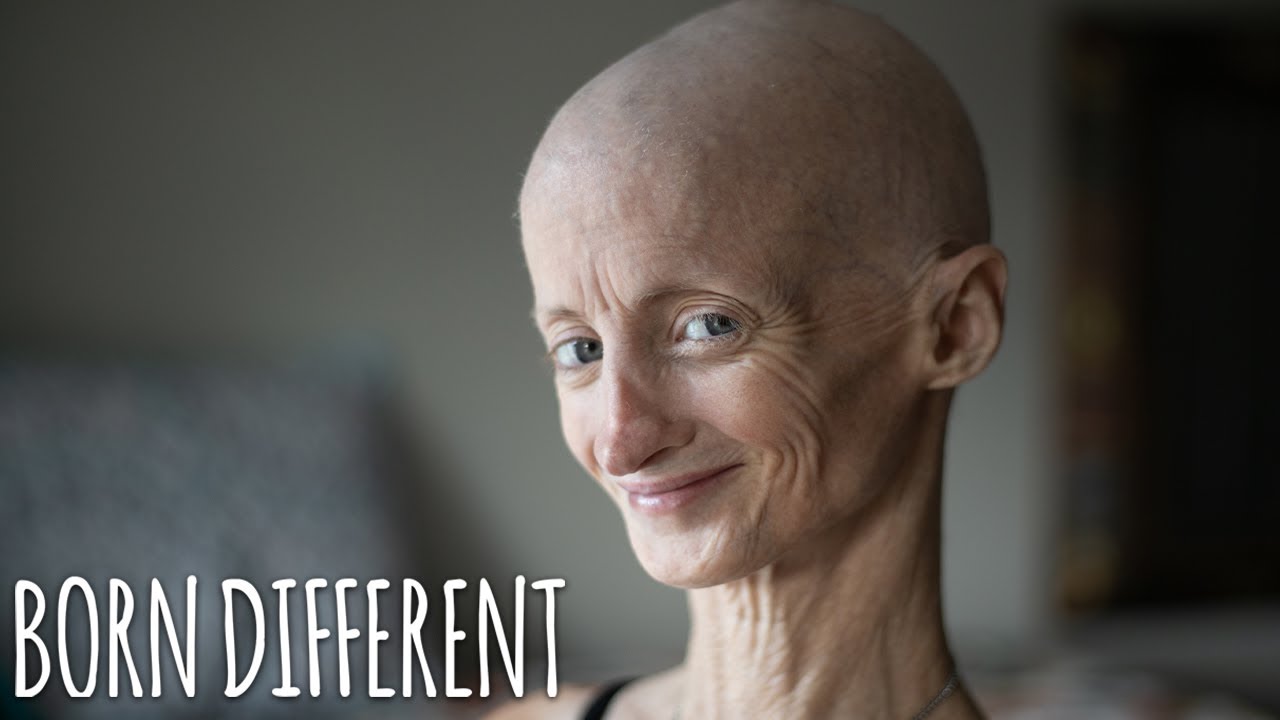 Progeria Has Taken My Teeth But Not My Smile | BORN DIFFERENT