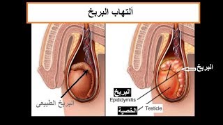 ألتهاب البربخ الأسباب والأعراض والعلاج