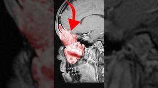 Thumbnail for "They kept saying my headaches were a sinus infection..."