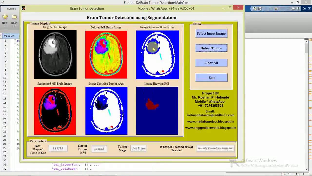 Brain Tumor Segmentation Using Matlab Project Source Code Final Year ...