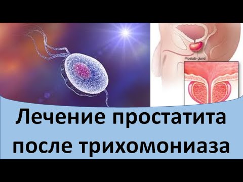 Лечение простатита после трихомониаза