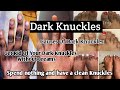 Dark Knuckles / What Causes Dark Knuckles / How To Stop Recurring Dark Knuckles