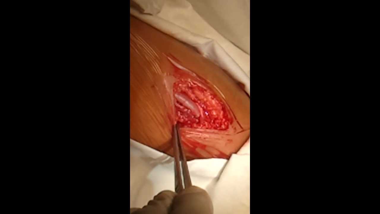 Pulse of of brachial artery. - YouTube