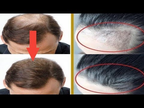 Video: Alopecija (ćelavost) Kod Muškaraca - Kako Zaustaviti ćelavost? Pripreme, šamponi