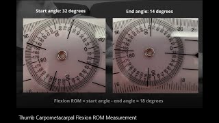 Range of Motion Measurement: Thumb Carpometacarpal (CMC) Flexion