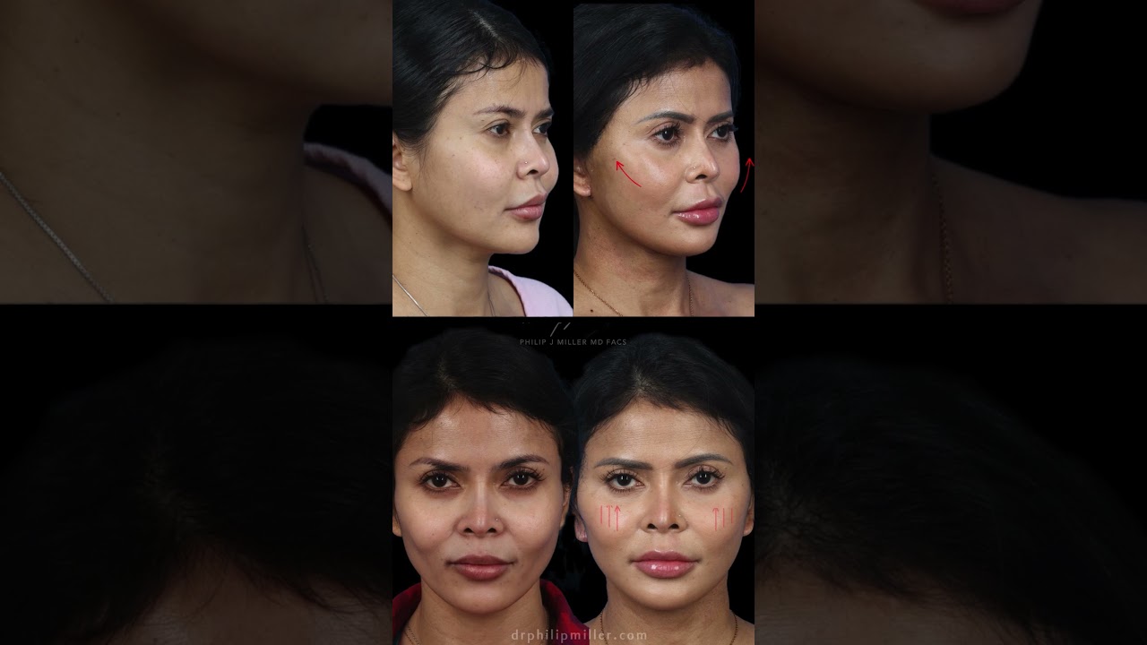 Instant Lift, Minimum Downtime: MicroLift Before & After Results