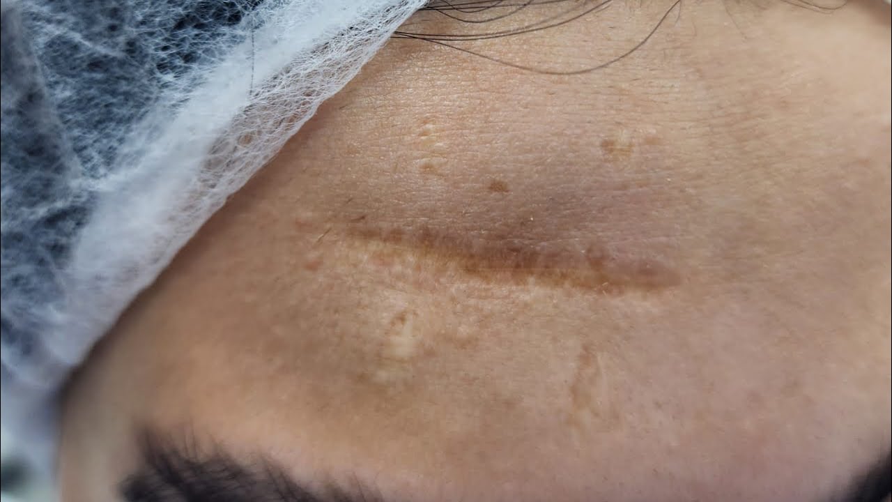 طريقة الغيار باستخدام لاصقات التجميل وكيفية شيلها و ووضعها والنصايح بعدها د صابر عبد المقصود استشاري