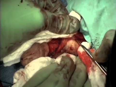 Small blisters on the penis
