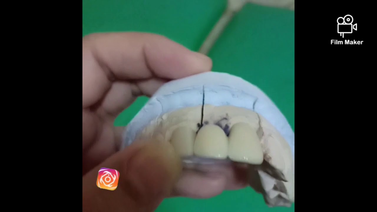 Bagaimana sih bentuk gigi tiruan Emax?