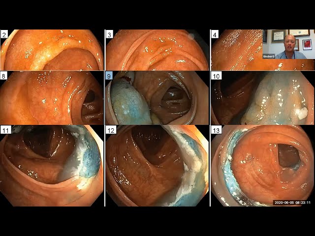 Serrated Colon Lesions: How Best to Manage?