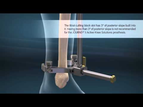 JOURNEY II TKA (Total Knee Arthroplasty) Animation