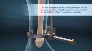 JOURNEY II TKA (Total Knee Arthroplasty) Animation