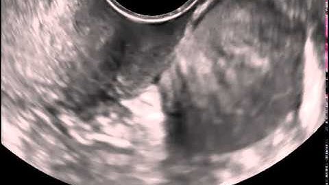 Ultrasound in Obstetrics & Gynecology: A Practical Approach - Clip 11.1