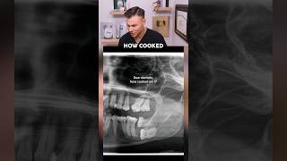 Dentist Reveals Very RARE Tooth Condition! 😮🦷
