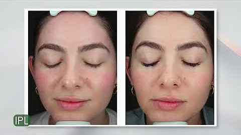 IPL Laser:  very effective to treat dark spots, fine lines and more!