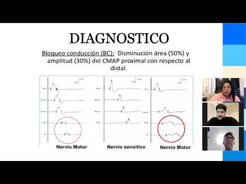 Video: Rozšírenie Fenotypu Syndrómov PRPS1 U žien: Neuropatia, Strata Sluchu A Retinopatia