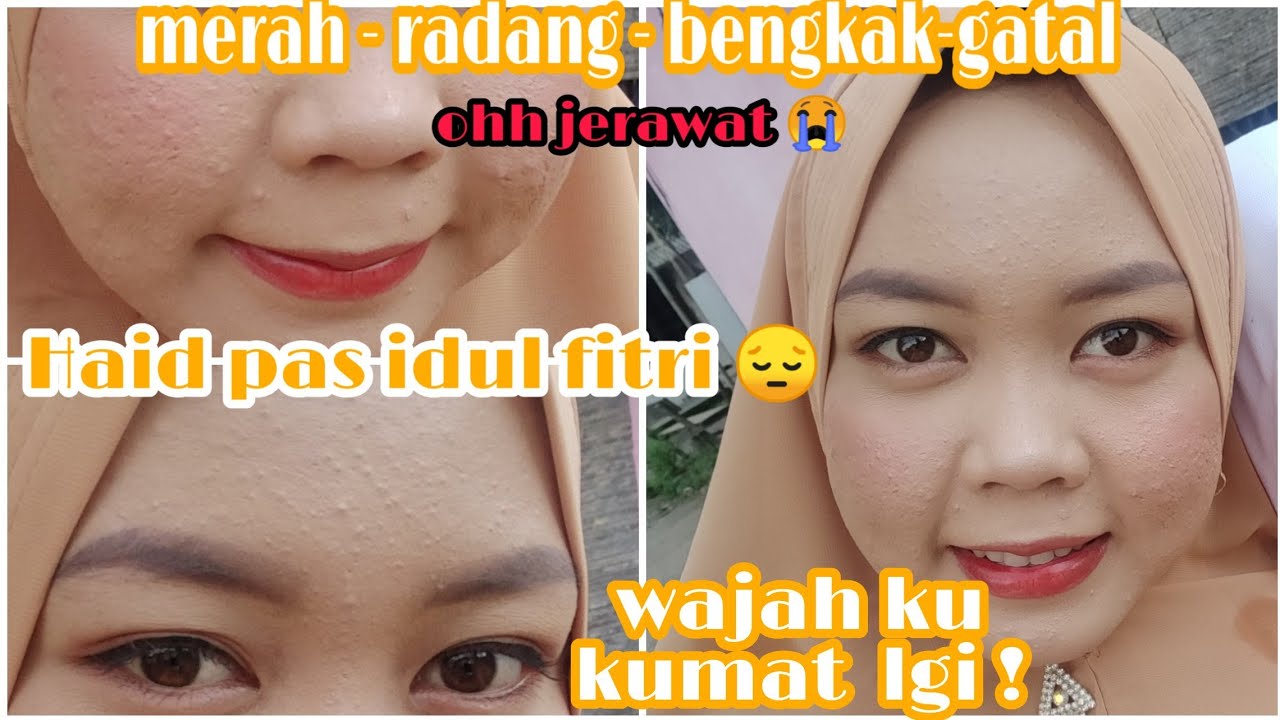 JERAWAT HAID | Gini wajah ku tiap bulan nya kalo lagi haid :'( 