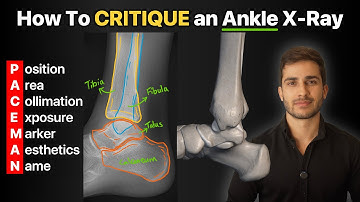 How To Critique an Ankle X-Ray!