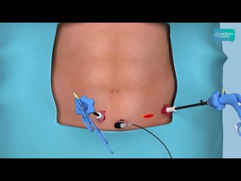 Vídeo: Cirurgia De Diverticulite: Procedimento, Recuperação, Riscos E Muito Mais