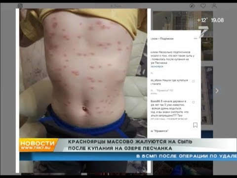 Красноярцы массово жалуются на сыпь после купания на озере Песчанка