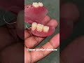 Upper partial denture 😬😬😬#apexdental #splittooth #orthodontist #dentistry #partialdenture