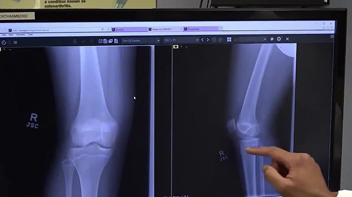 BEAR Implant Preserves the ACL