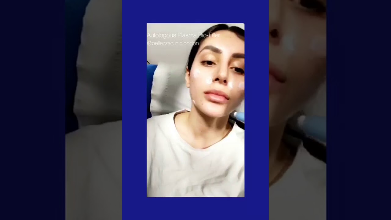 Plasma Bio Filler