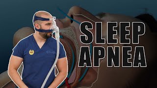 Sleep Apnea | Gastric Sleeve Surgery | Questions and Answers