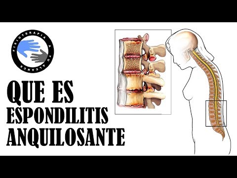 Vídeo: Poner La Espondilitis Anquilosante En Su Lugar: Remisión