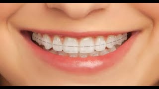 مص الاصبع - انوع التقويم و الابتسامه - حقائق و استفسارات عن الاسنان