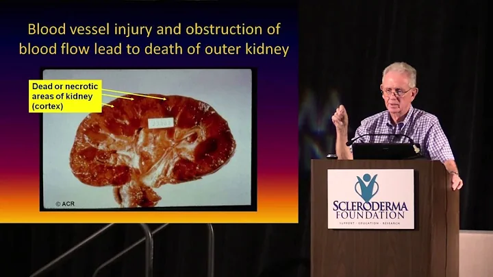 2015 Nashville- Kidney Involvements in Systemic Sc...