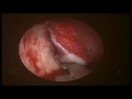 Endoscopic dcr  case 1   dr satish jain  wwwskullbase360in