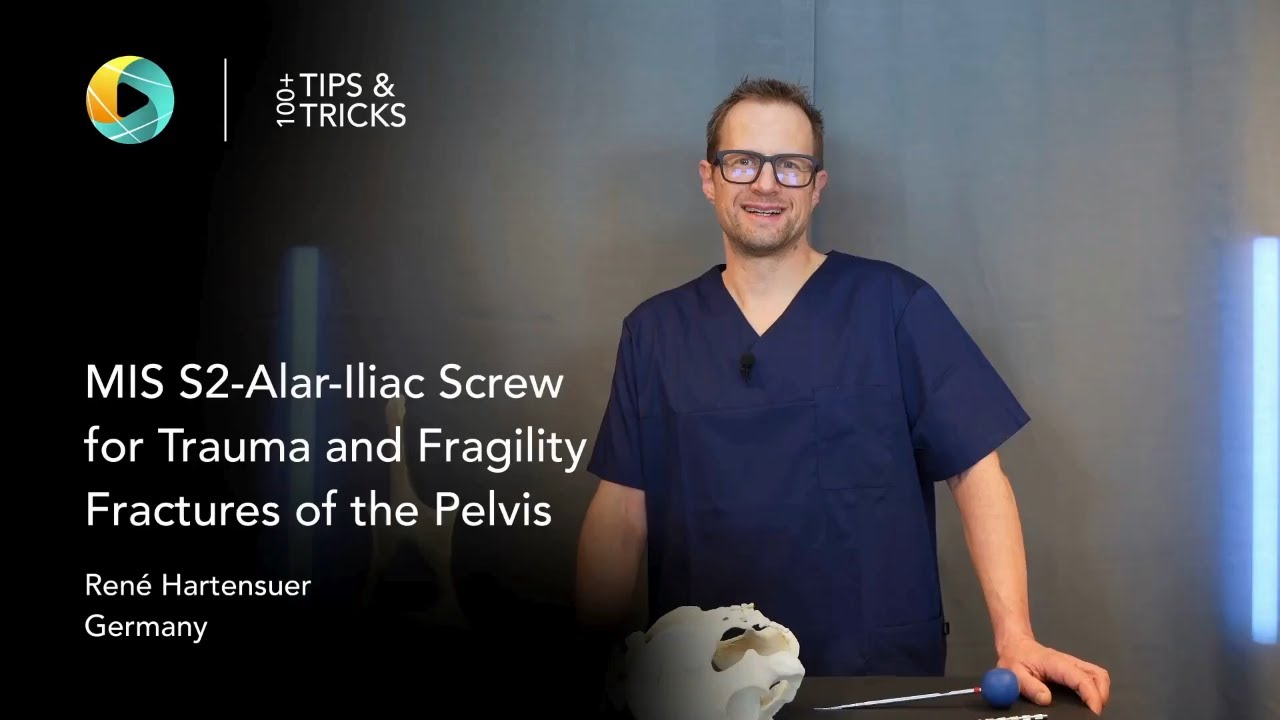 Винт S2-крыловидно-подвздошный для лечения травматических и хрупкостных переломов таза (МИС) (Рен...