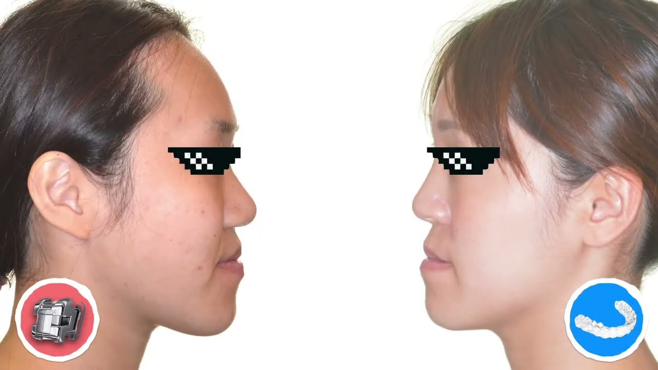 Treating high canines：Aligners vs Self-ligation｜【Chris Chang Ortho】CC710