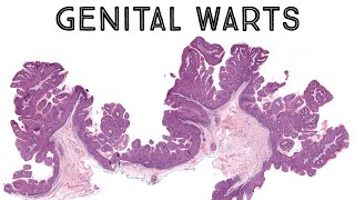 Genital warts under microscope (condyloma acuminatum HPV pathology dermpath dermatology) screenshot 3