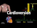 Cardioversion (Electrical) Procedure, Animation