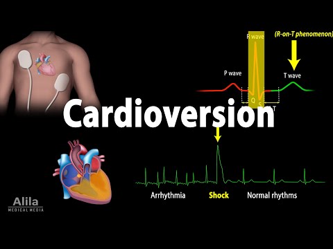 Vídeo: Como evitar que Afib retorne: 14 etapas (com fotos)