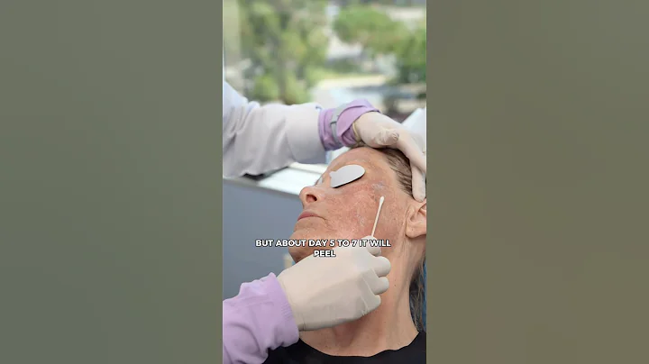 Erase 5 Years of Sun Damage in One Treatment