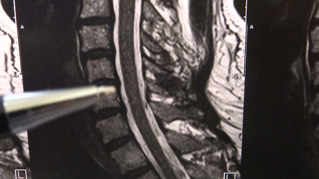 Ressonância para a cervical, sempre tem relação com a dor?