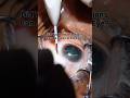 Did You Know Injections Can Be Given in the Eye? Orzudex eye injection